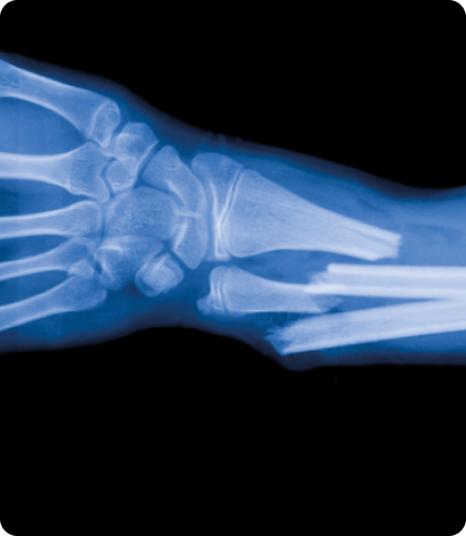 Radiografía en color azul que muestra una fractura en el antebrazo con presencia de fijadores metálicos.